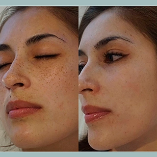 Фото лазерное омоложение кожи лица