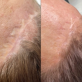 фото до и после Удаление шрамов и растяжек препаратом КОЛЛОСТ