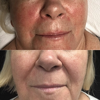 фото до и после процедуры сосудистые звездочки на лице у женщин