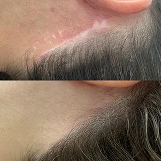 фото до и после перманентный макияж растяжек