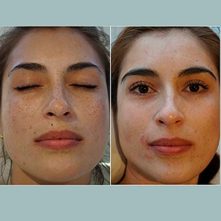 Фото до и после лазерное омоложение кожи лица