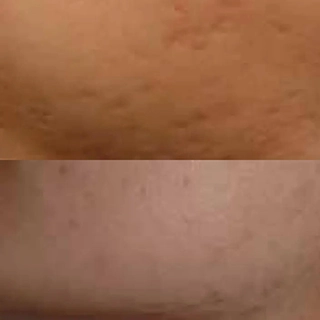 фото до и после Удаление шрамов и растяжек препаратом КОЛЛОСТ