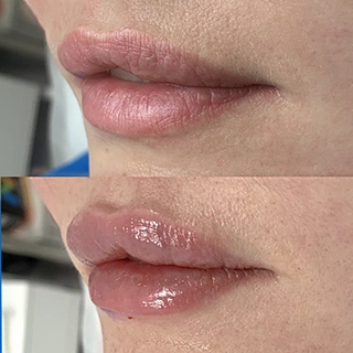 Фото контурная пластика губ врач Ольга Рейн