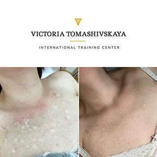 фото до и после коррекция рубцов татуажем мастер Томашивская Виктория