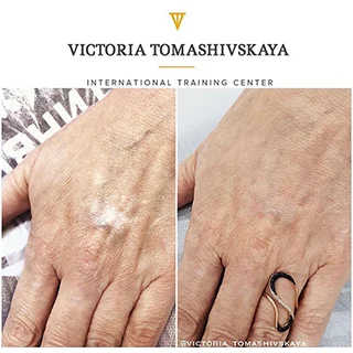 фото до и после коррекция рубцов татуажем мастер Томашивская Виктория