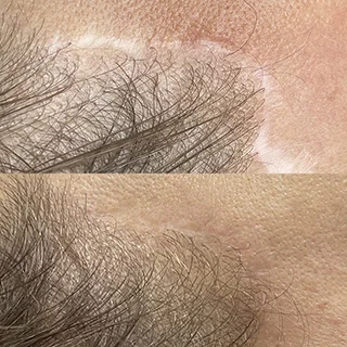 фото до и после перманентный макияж рубцов