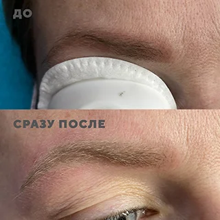 удаление перманентного макияжа до и после
