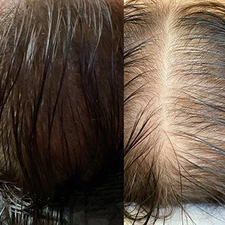 фото до и после трихопигментация волос в спб