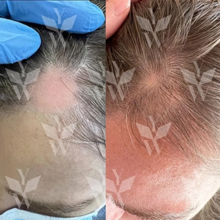 фото до и после озонотерапия в санкт-петербурге лечение для устранения причин алопеции